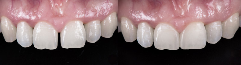 Dental Bonding used to close gap in teeth